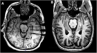 Ictal Onset Signatures Predict Favorable Outcomes of Laser Thermal Ablation for Mesial Temporal Lobe Epilepsy